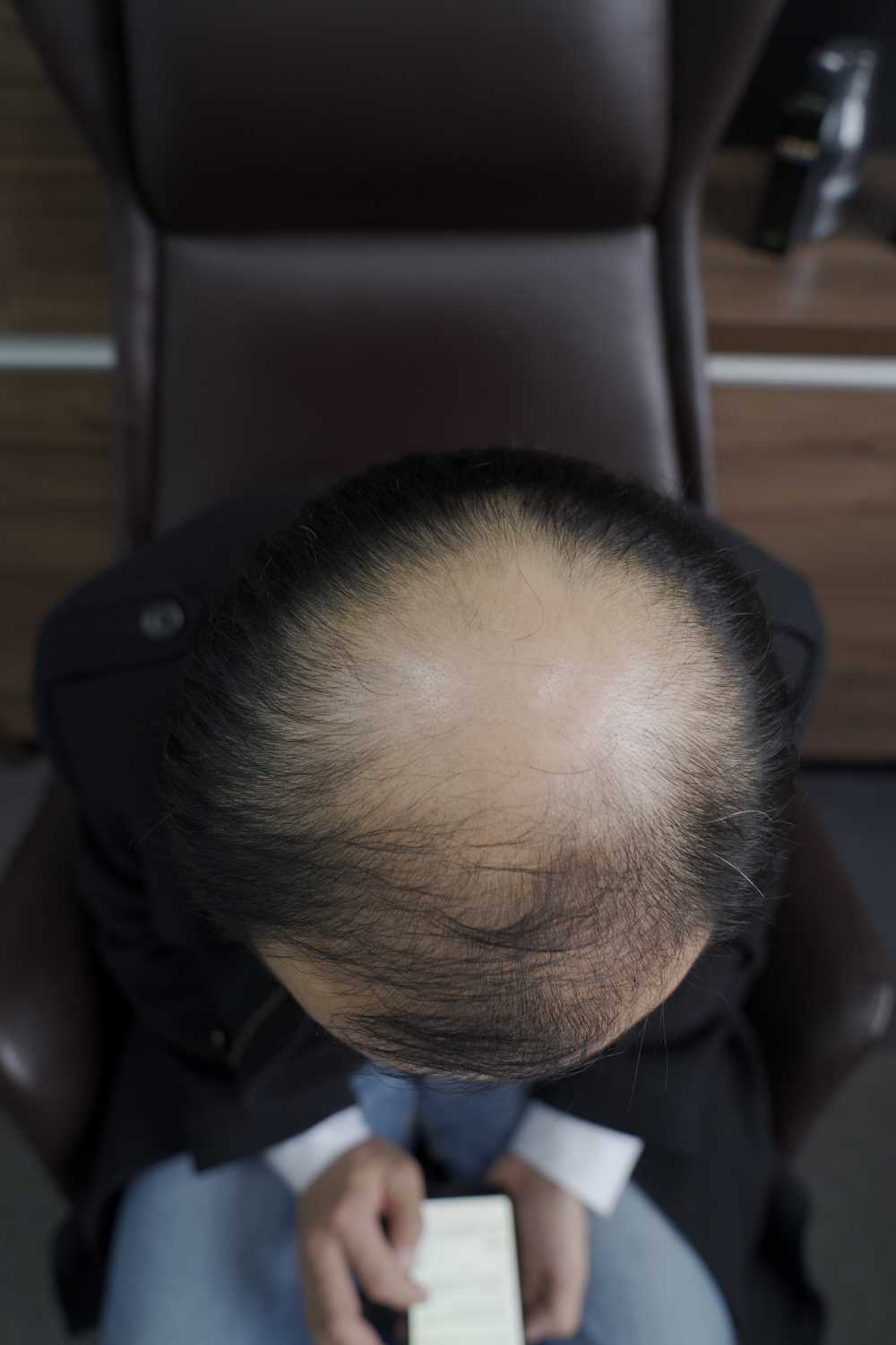 脱发素材 男性 11