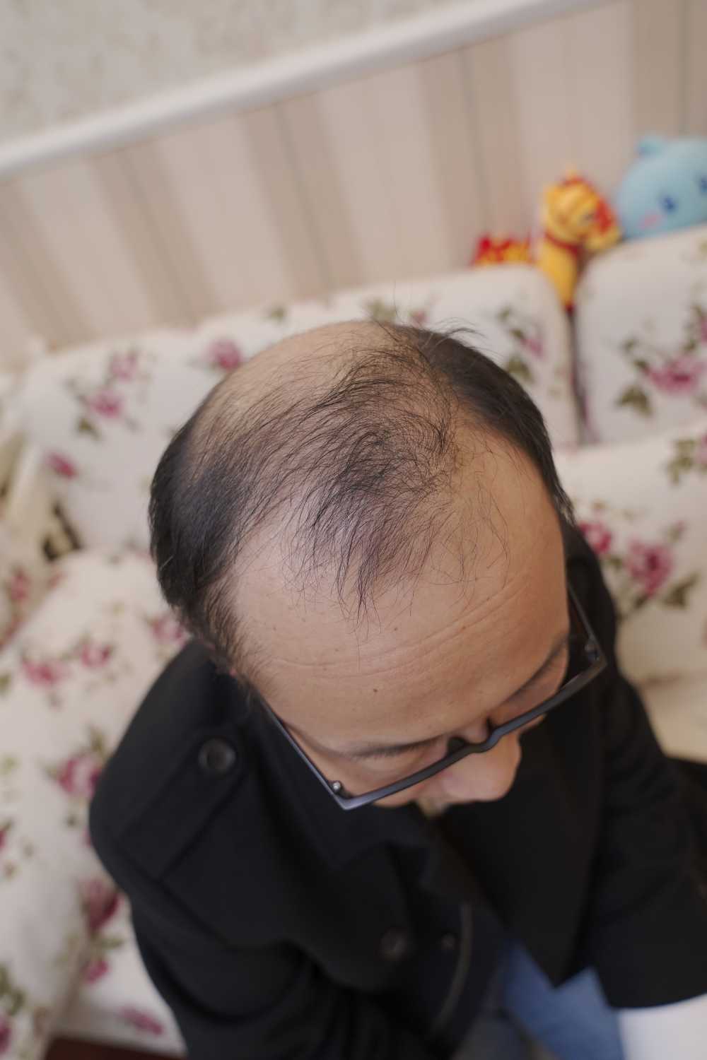 脱发素材 男性 31