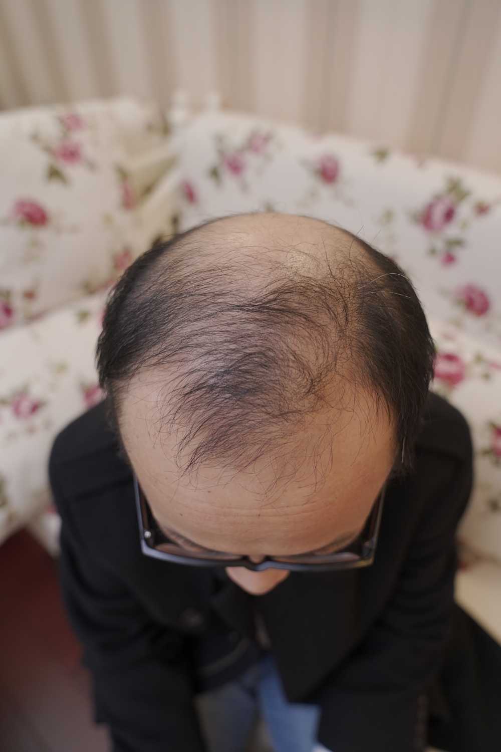 脱发素材 男性 32