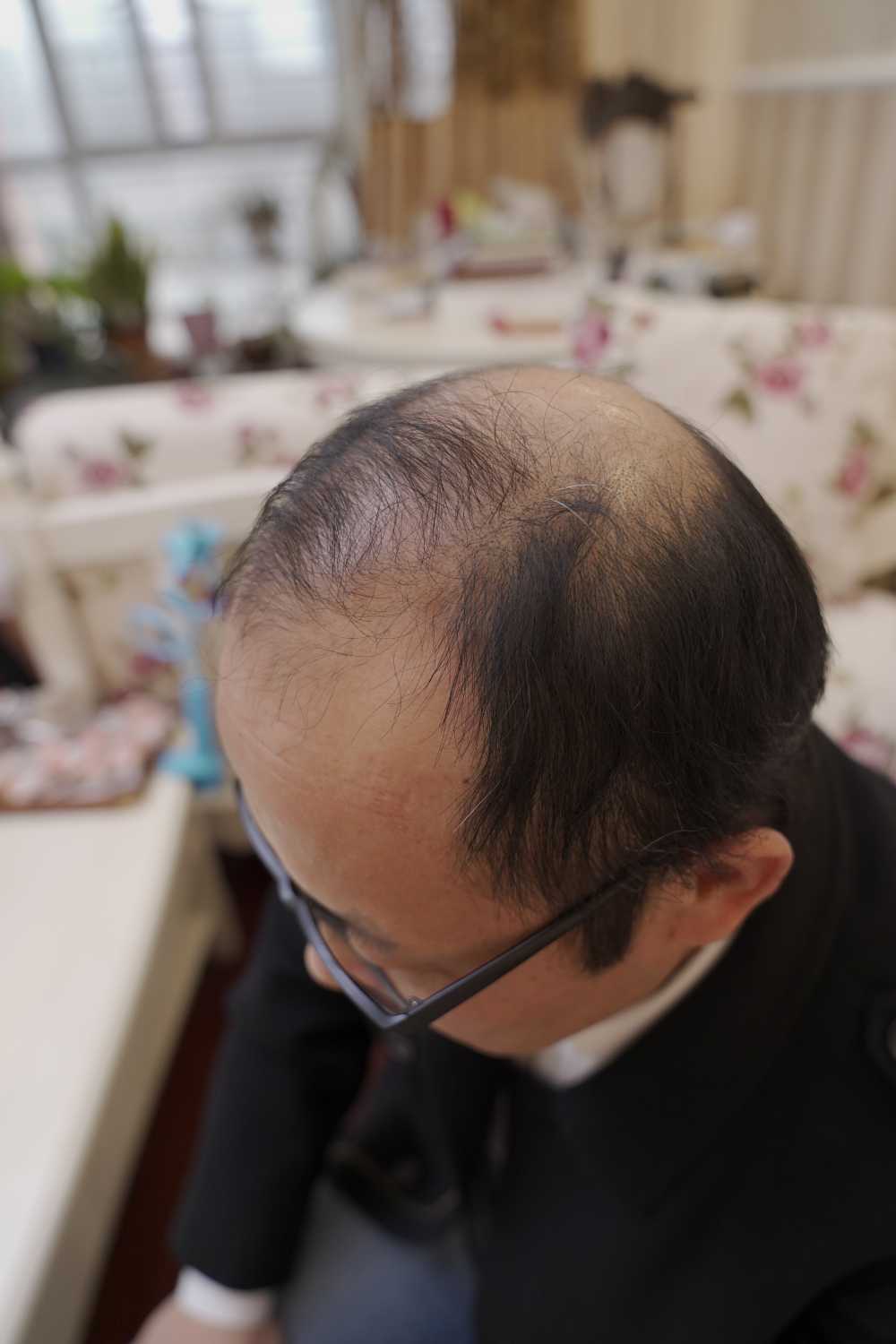 脱发素材 男性 30