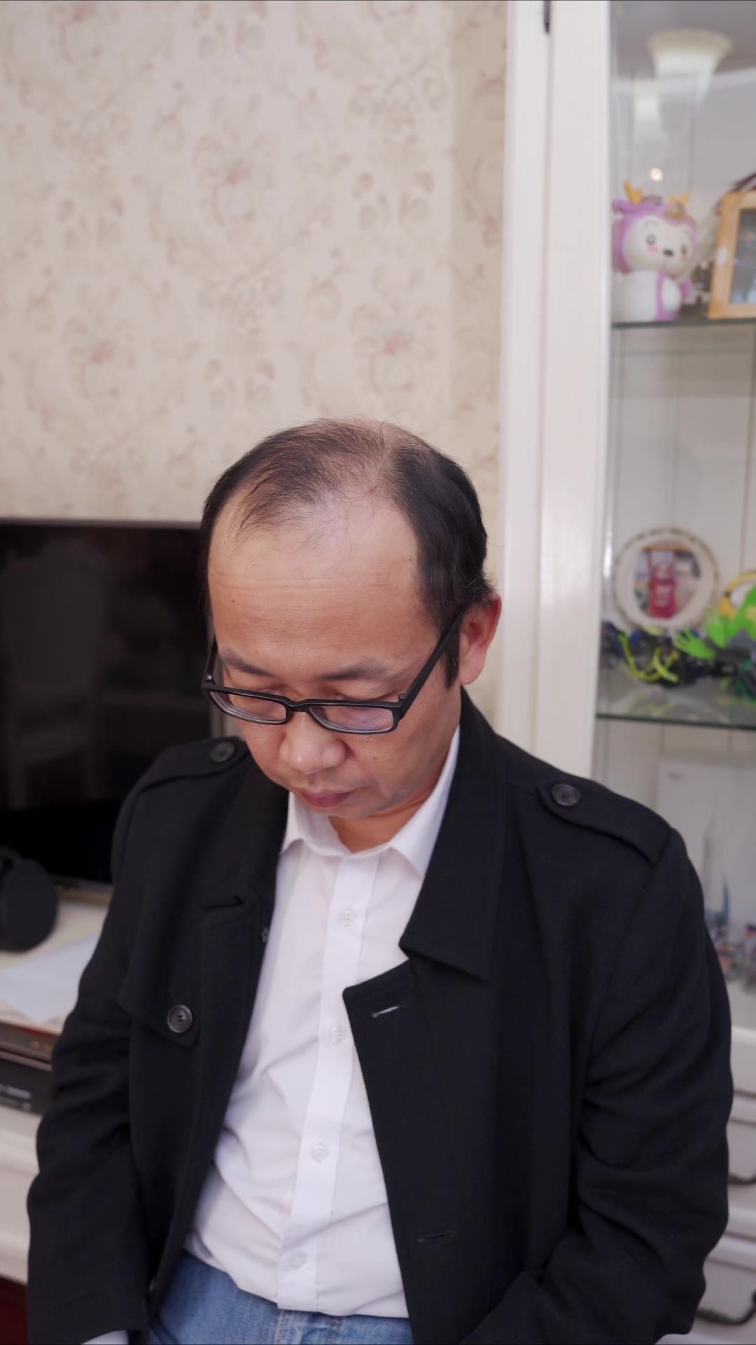 脱发 7