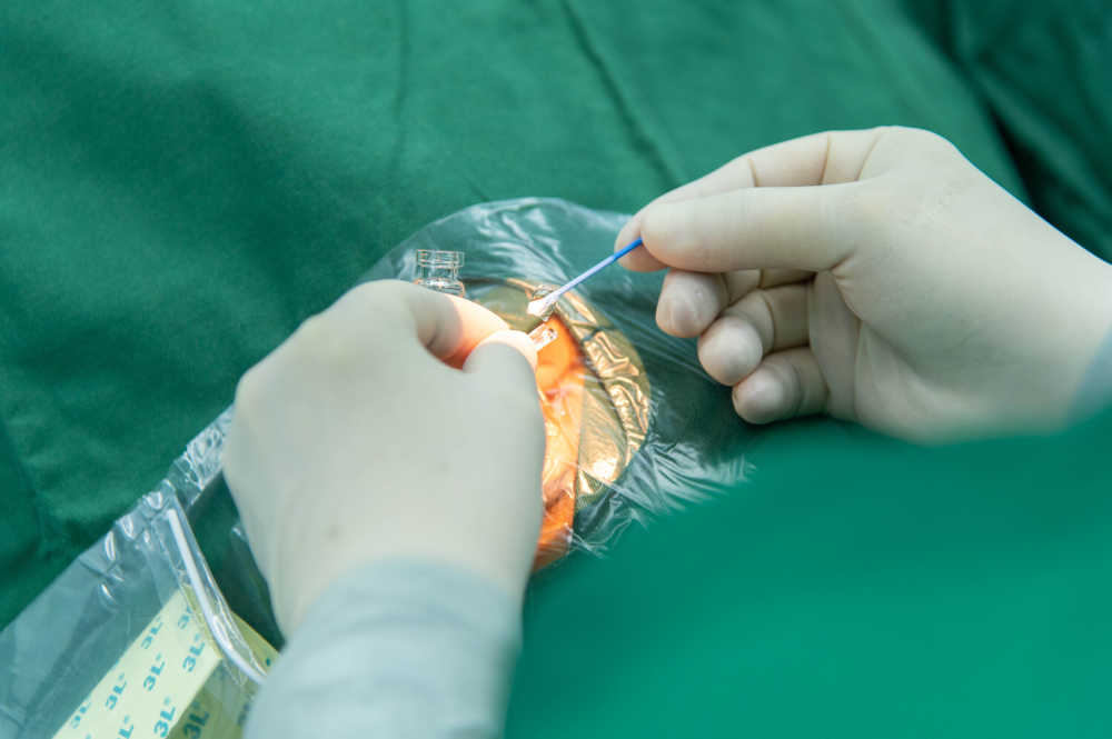 近视手术 晶体植入手术 ICL晶体