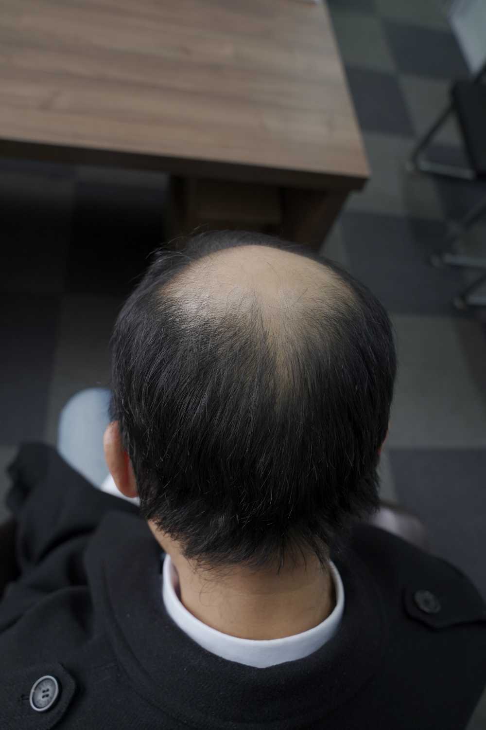 脱发素材 男性 10
