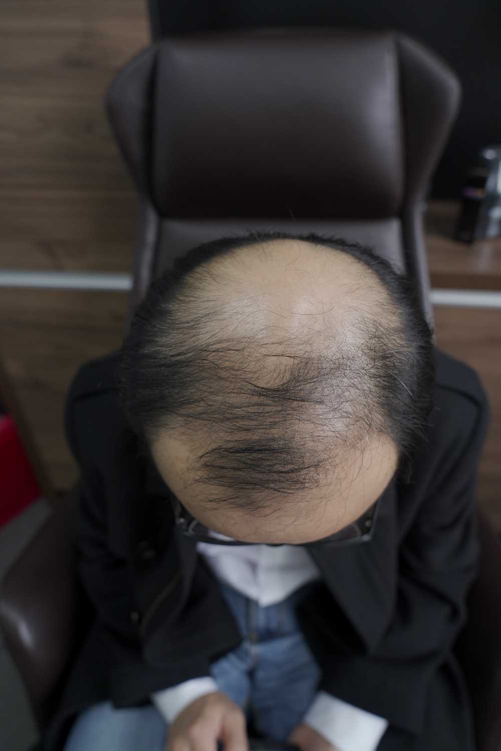 脱发素材 男性 7