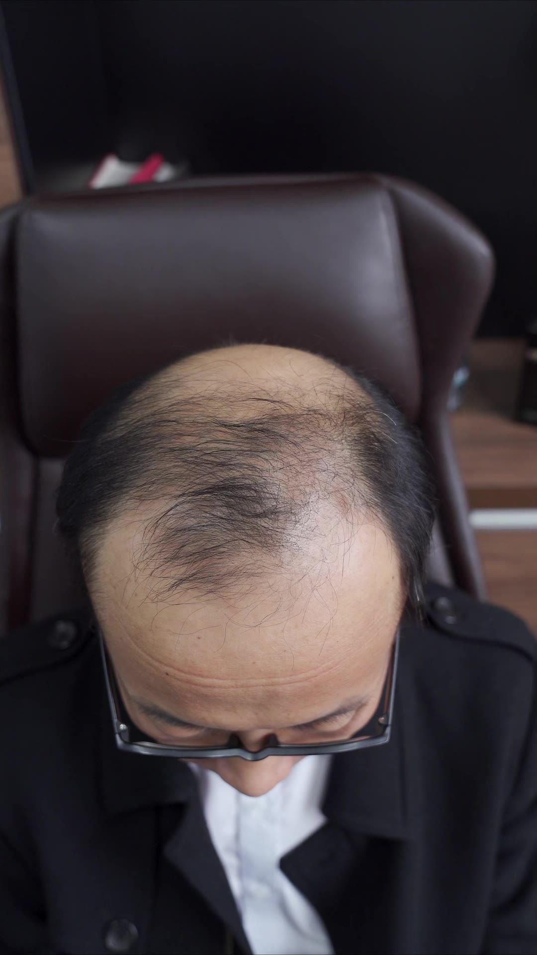 脱发 2