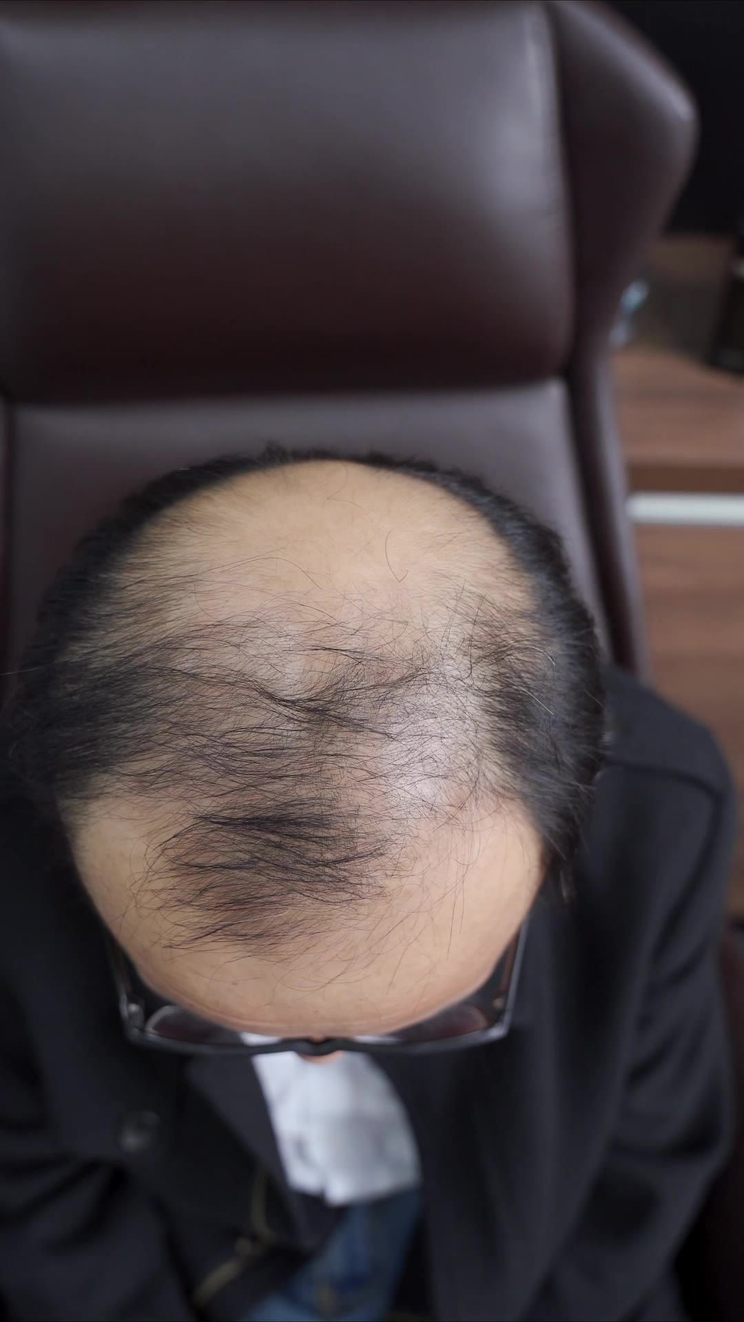 脱发 8