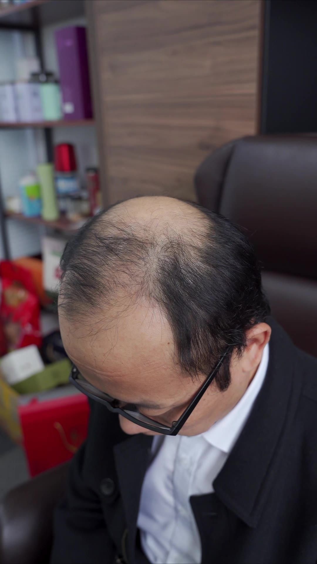 脱发 6