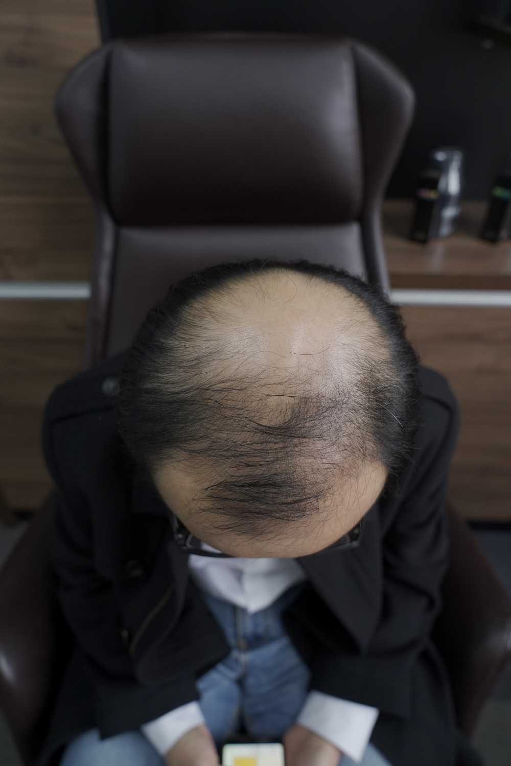 脱发素材 男性 22