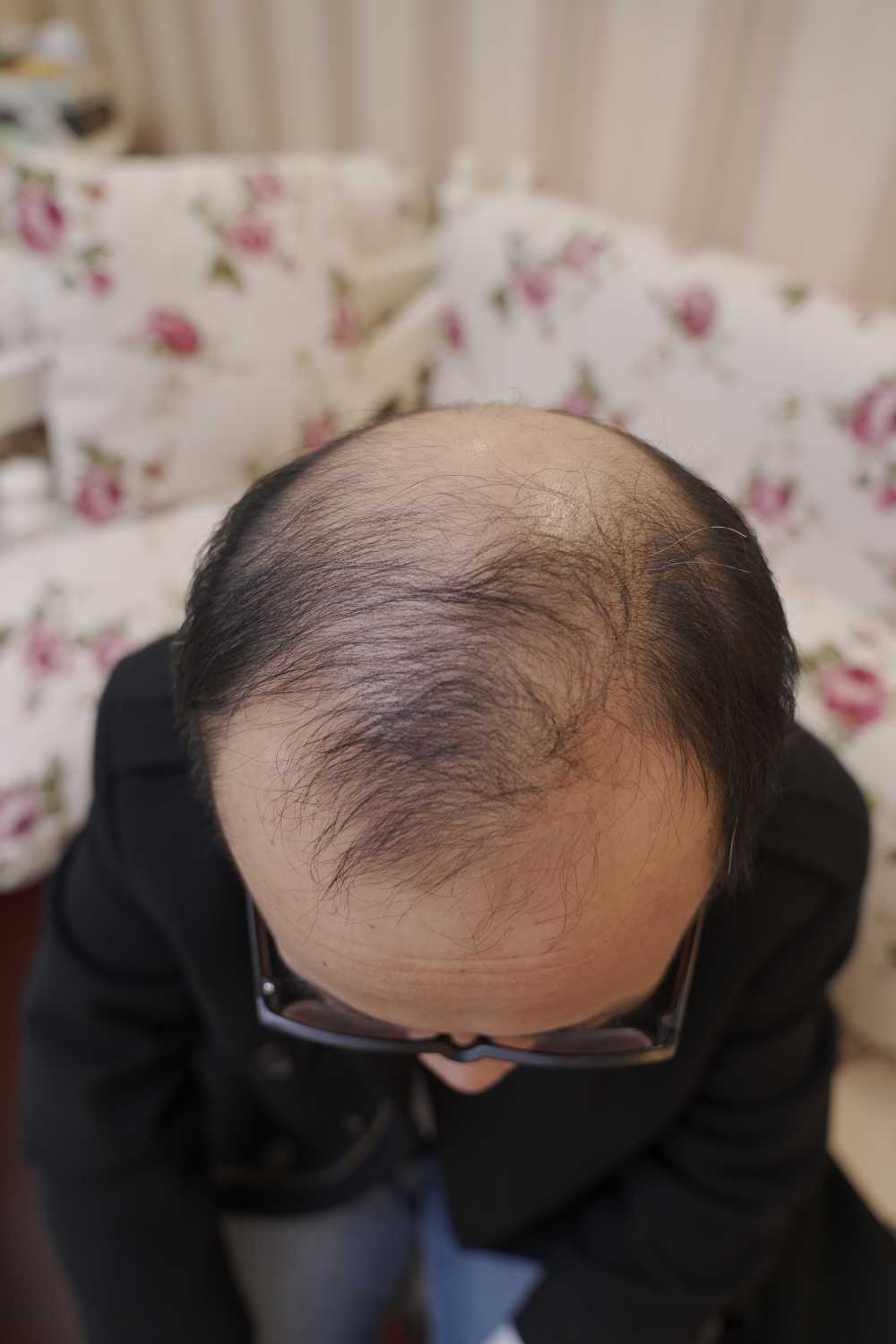 脱发素材 男性 29