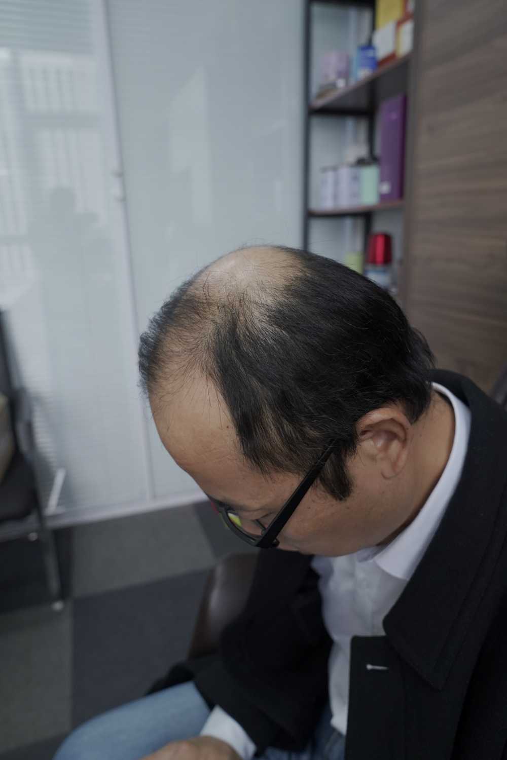 脱发素材 男性 8