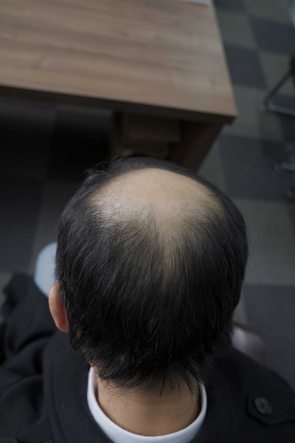 脱发素材 男性 9