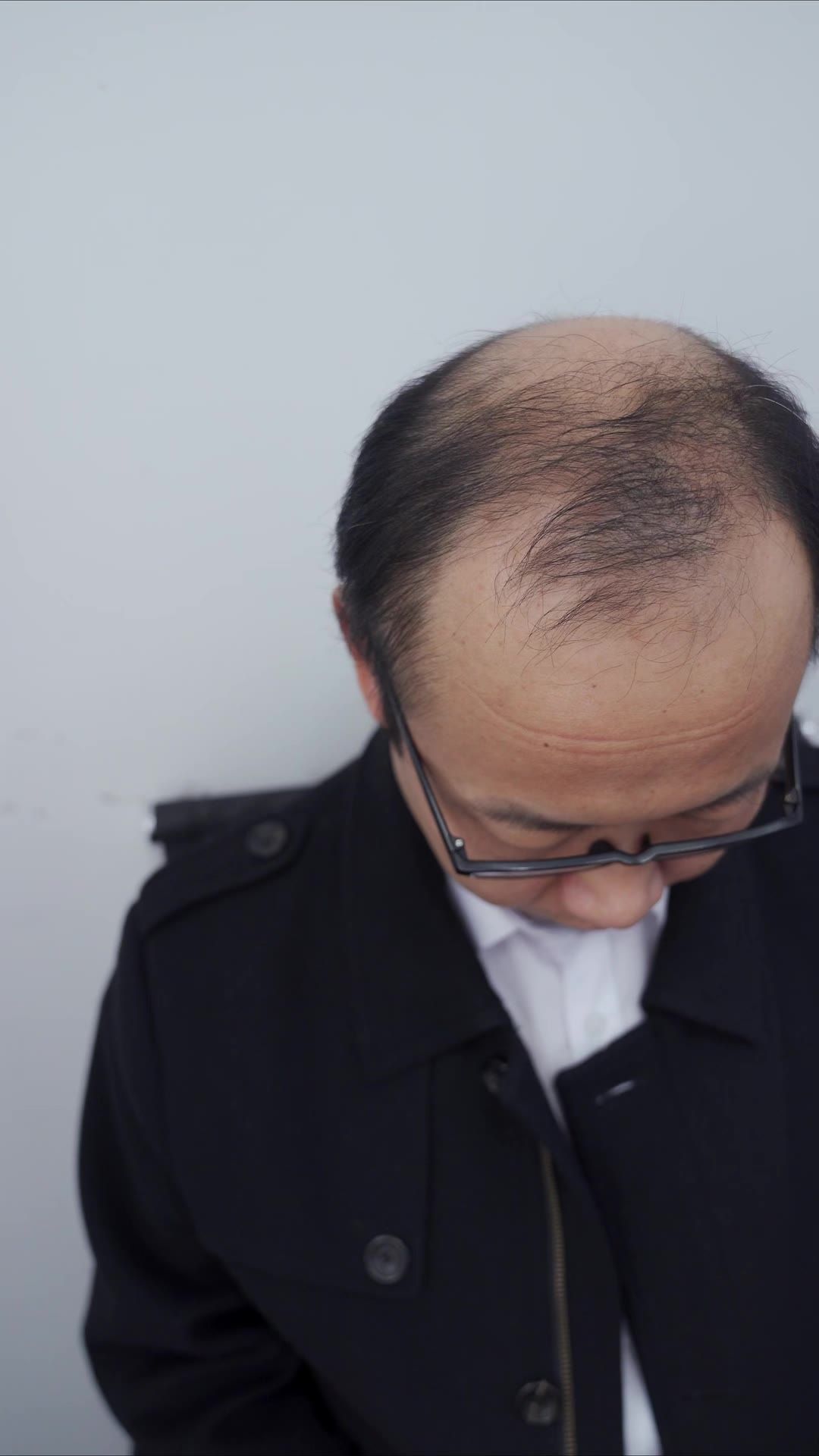脱发 13
