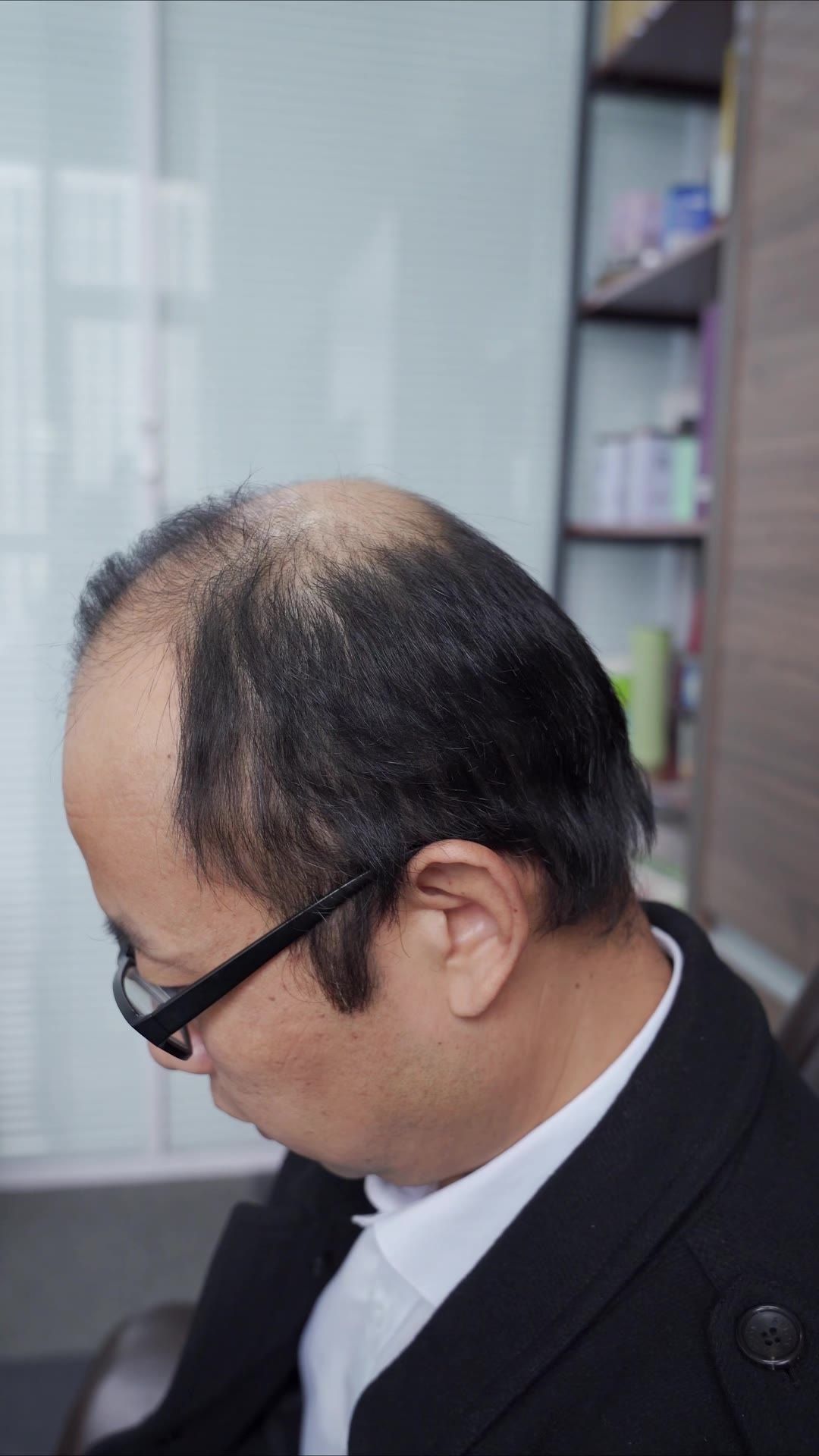 脱发 9