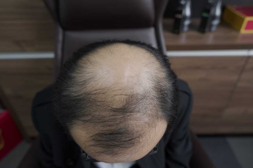 脱发素材 男性 5
