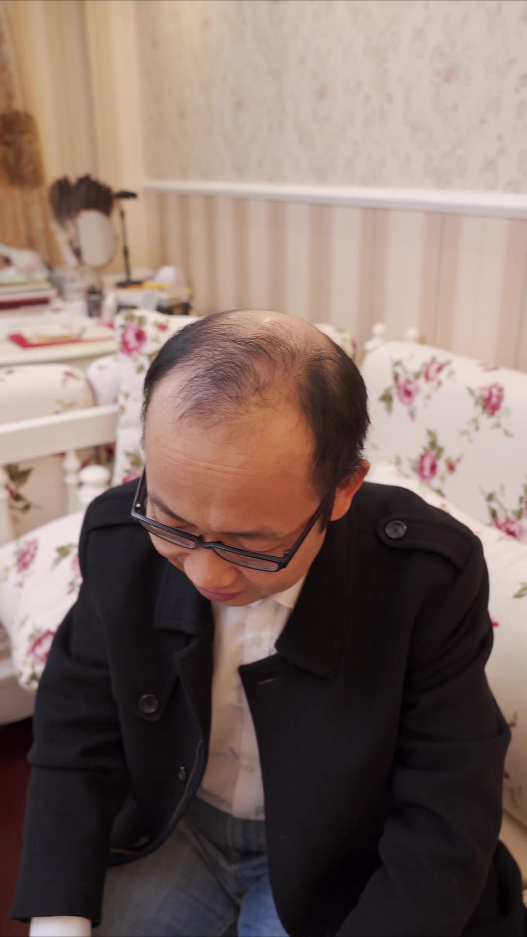 脱发 5
