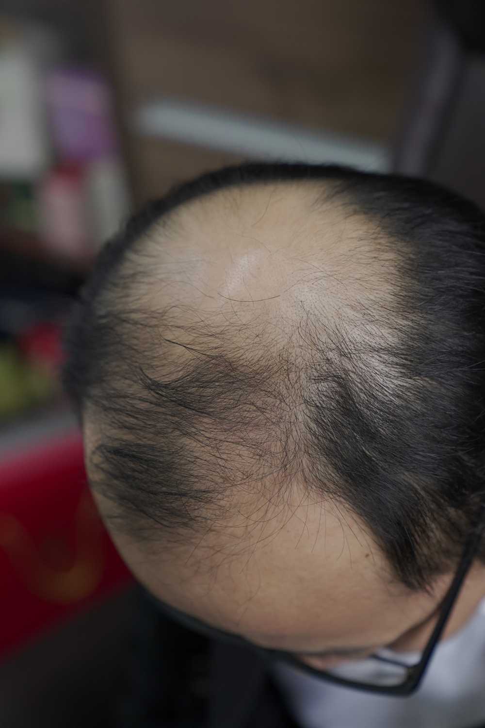 脱发素材 男性 15