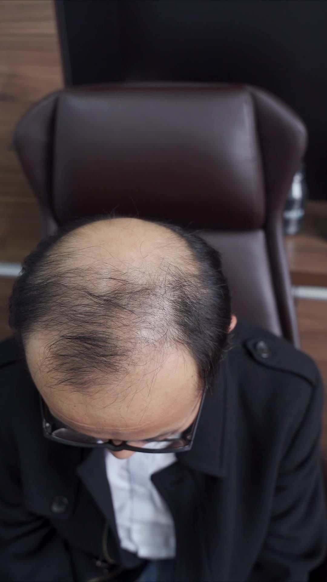 脱发 4