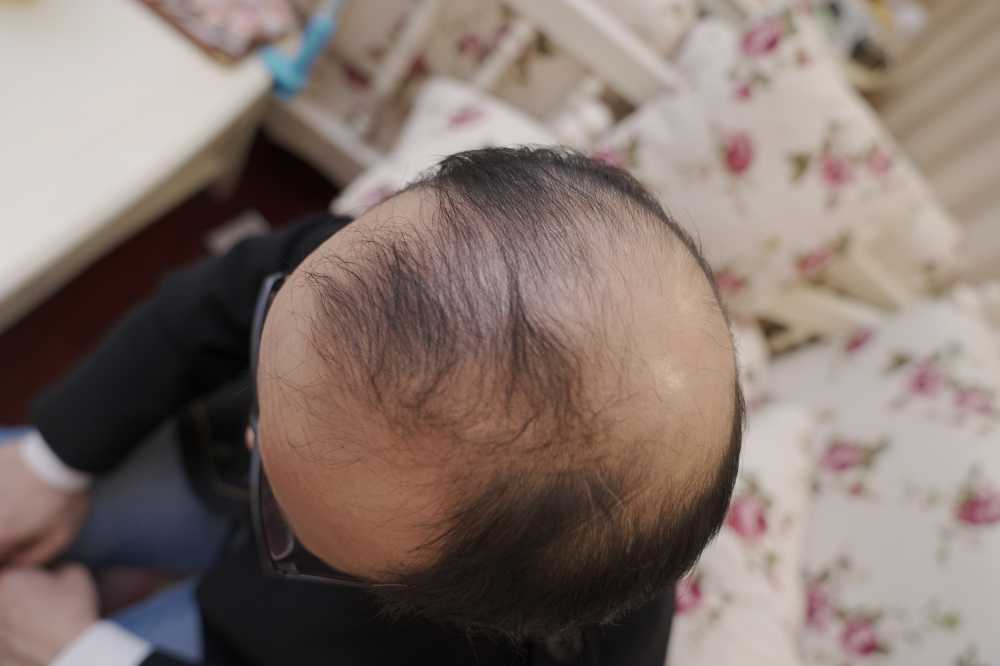 脱发素材 男性 28