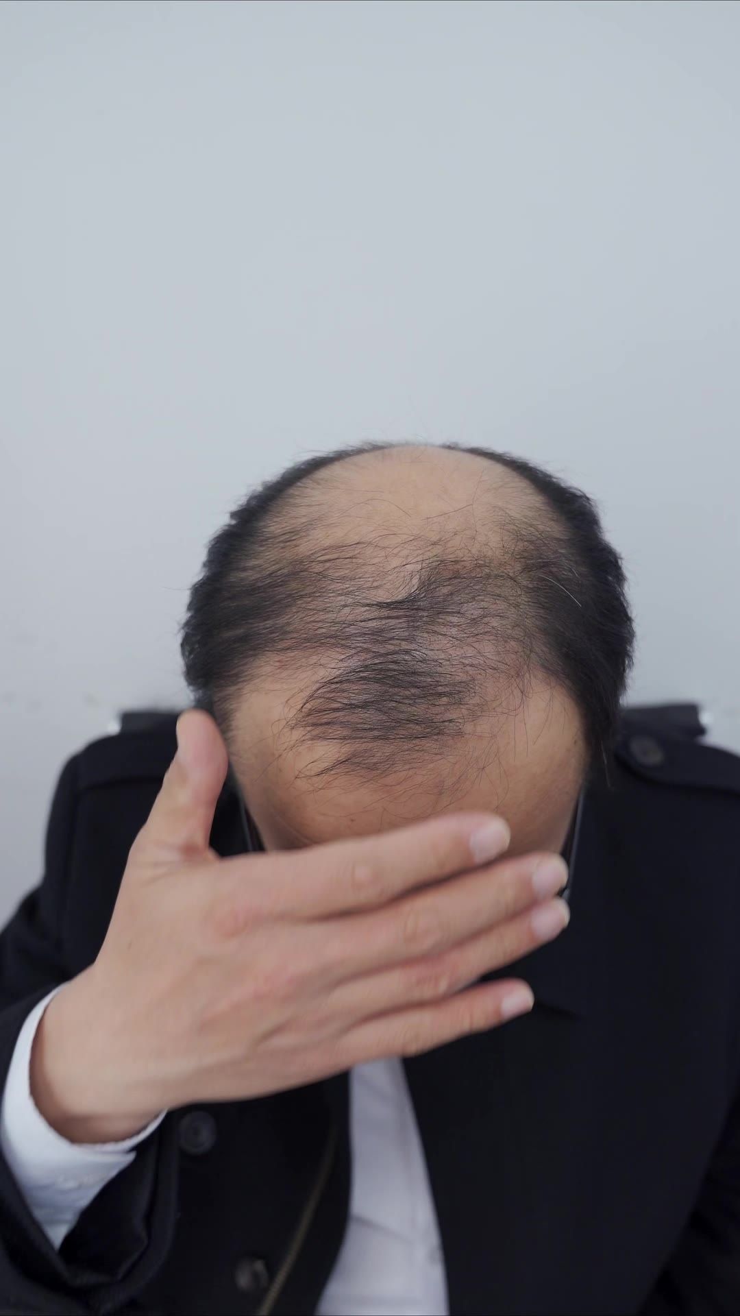 脱发 17