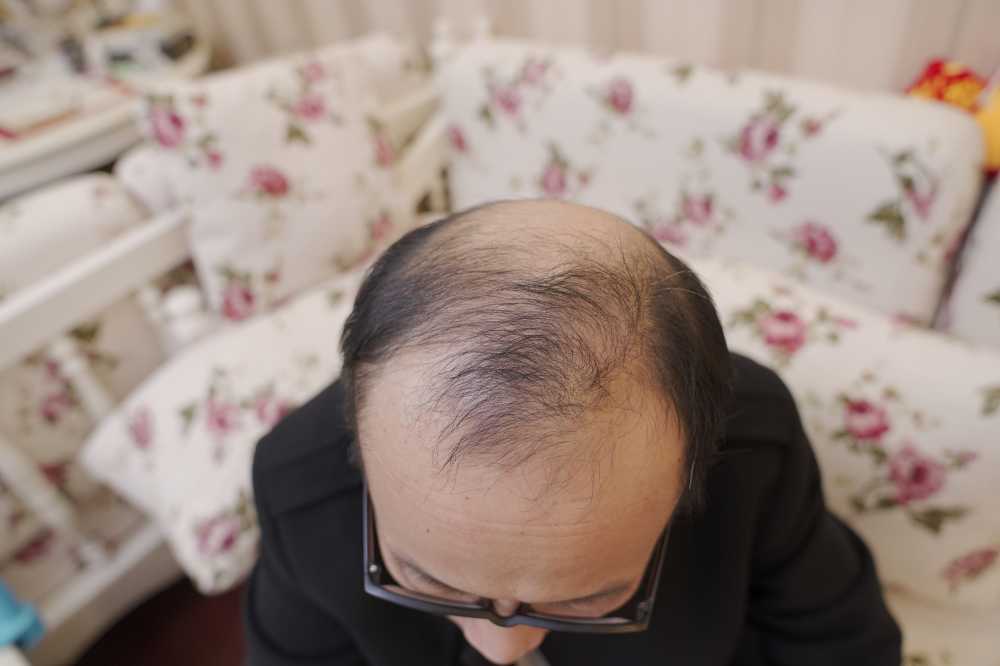 脱发素材 男性 27