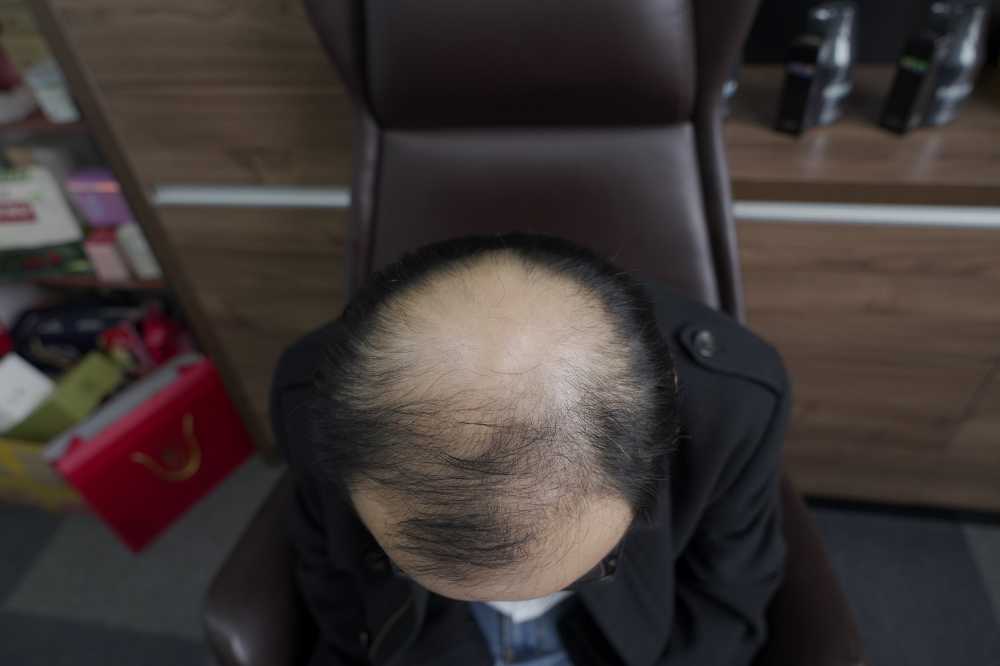 脱发素材 男性 2
