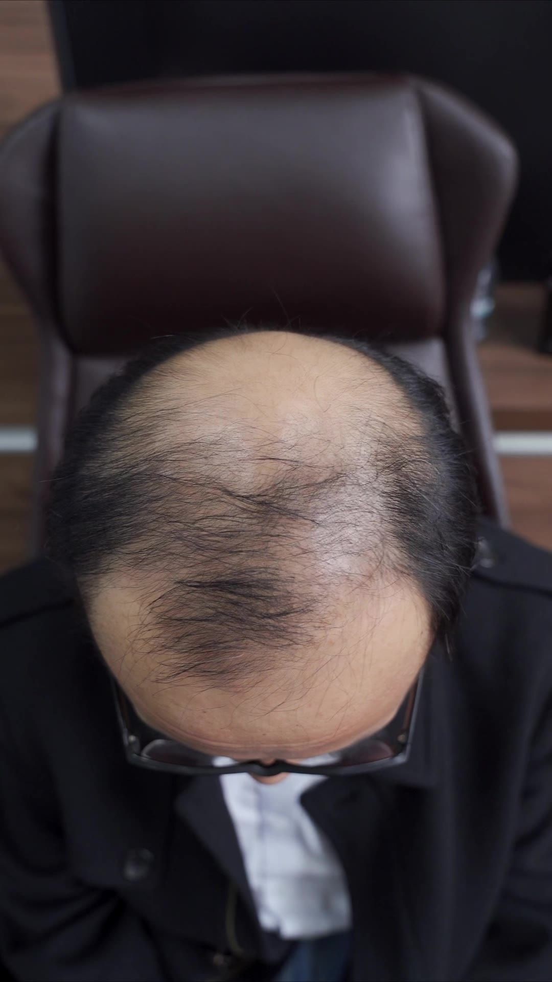 脱发 3