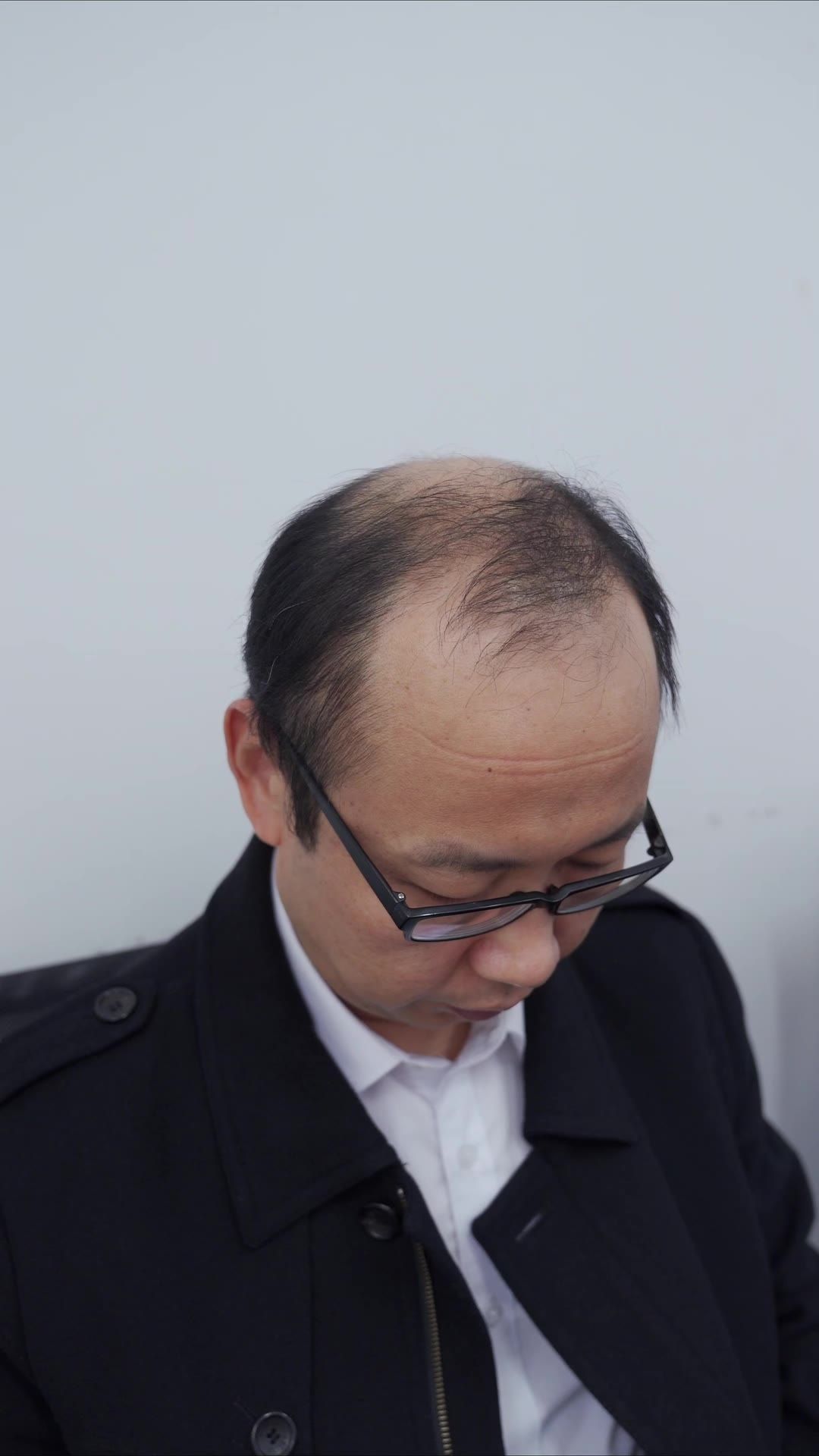 脱发 16