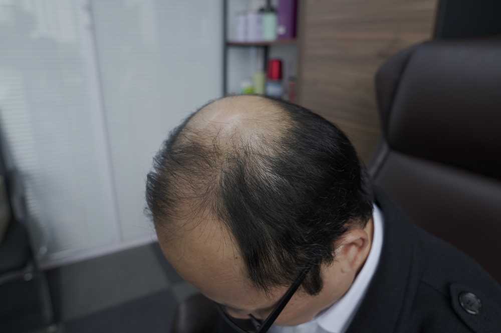 脱发素材 男性 3